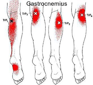 Trigger Point Chart Legs