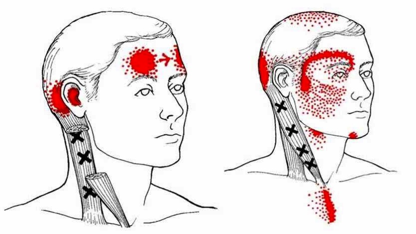 headache trigger points muscle sternocleidomastoid pain cluster active scm therapy swallowing dizziness misdiagnosed jaw