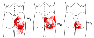 Gluteus Maximus tps