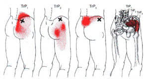 Gluteus Medius trigger points