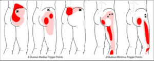gluteus minimus tps