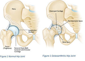 hip arthritis