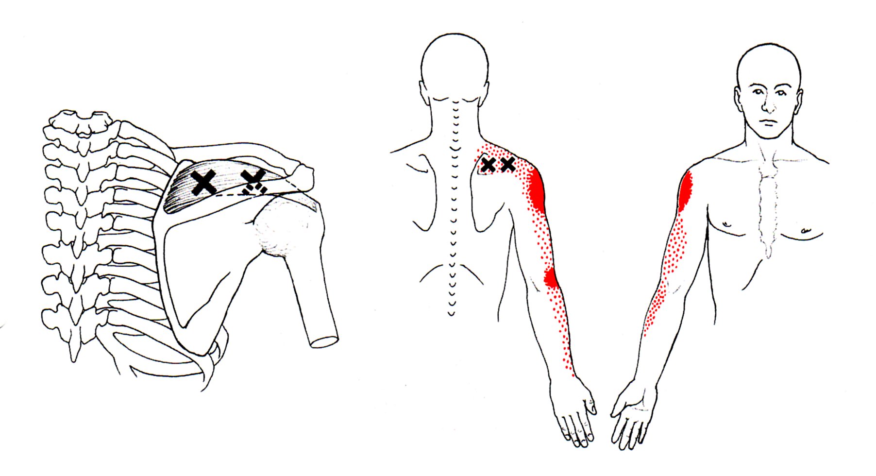 Иррадиация боли в левую лопатку. Триггерные точки надостной. Надостная мышца триггерные точки. Триггерные точки плеча. Надостная мышца плечевого сустава триггерные точки.