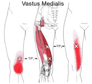 vastus medialis text